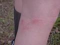 Rope burn on Gretchen's leg